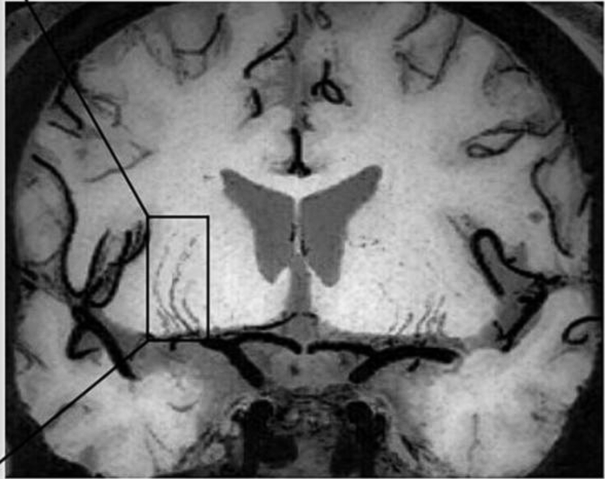 Lenticulostriate arteries
