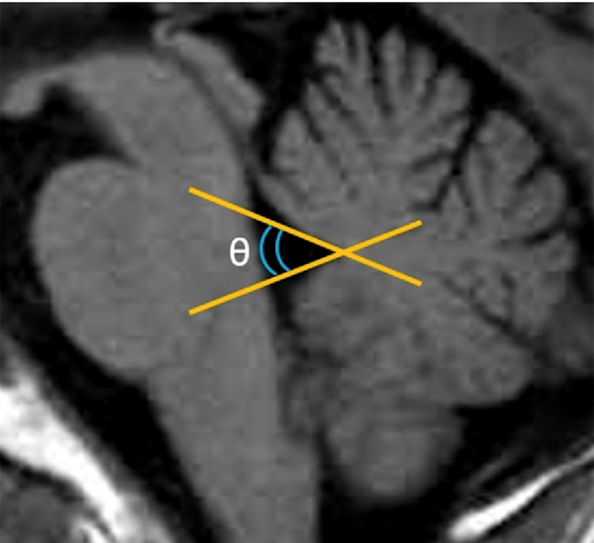 Midsagittal T1-weighted image of a patient showing the fastigial angle (θ) formed by the two lines tangent to the superior and inferior medullary velums