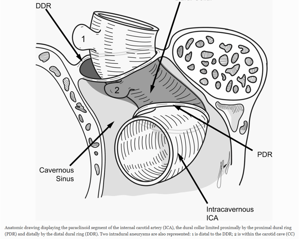 Proximal dural ring and distal dural ring arises above and below the anterior clinoid process 