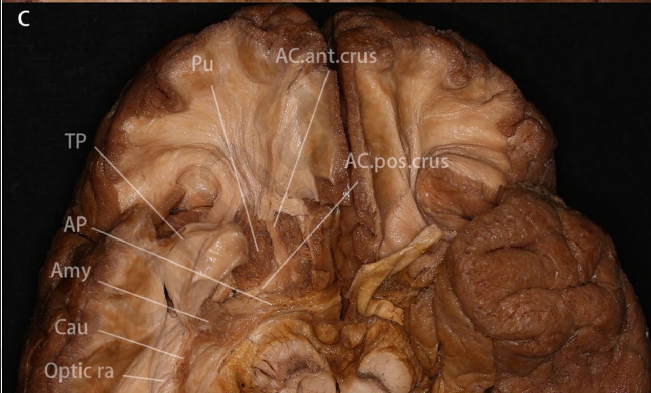 C: The lateral and medial olfactory stria, the olfactory tubercle and anterior perforated substances were removed to expose the anterior commissure, putamen and ansa peduncularis. The ansa peduncularis is identified inferior and posterior to the anterior commissure, anterior to the cerebral peduncle and running laterally to the amygdala and anterior temporal cortex.