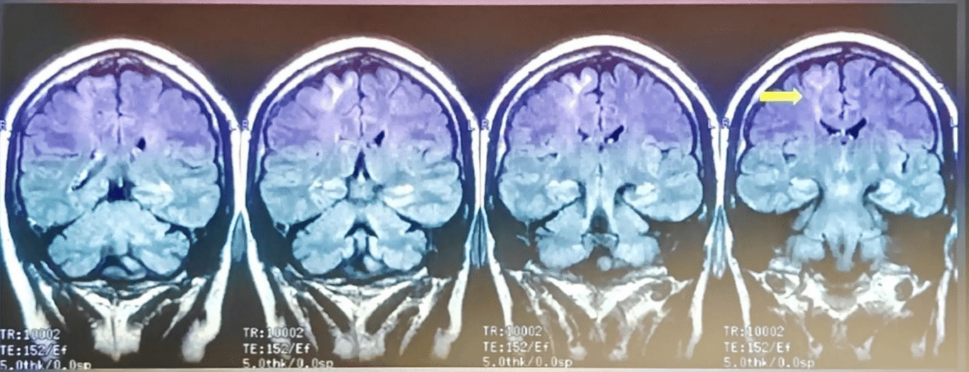 Abnormal proliferation of neuronal and glial cells. Focal cortical dysplasia. Need to correlate seizure semiology hx and EEG
