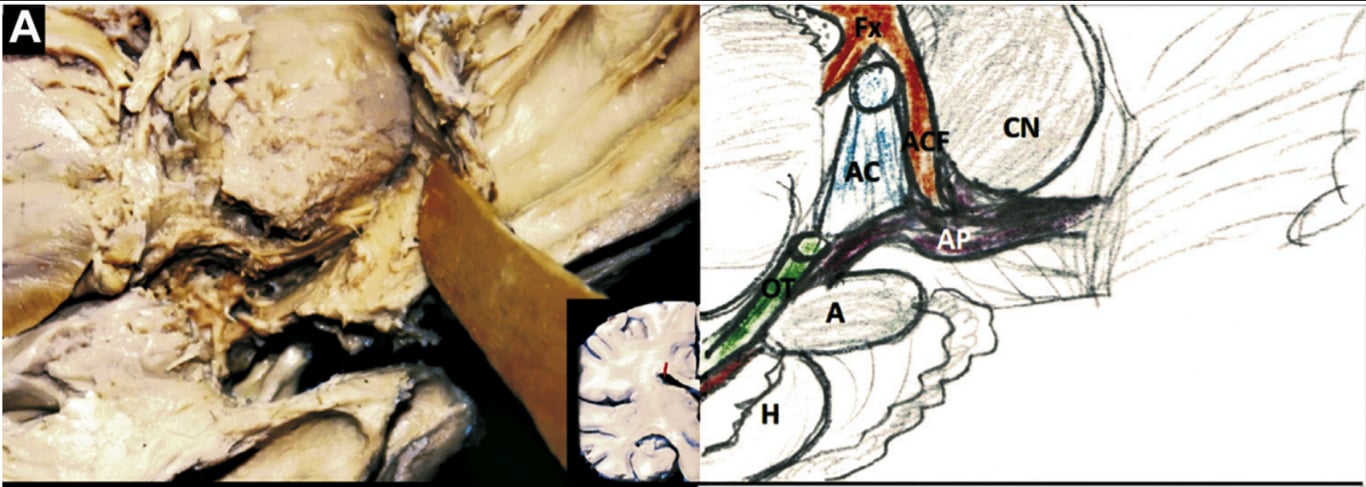 Fx, fornix; AC, anterior commissure; ACF, anterior column of fornix; CN, caudate nucleus; AP, ansa peduncularis; OT, optic tract; A, amygdala; H, hippocampus; DCg, dorsal cingulum; ST, stria terminalis; T, thalamus; FH, fimbria hippocampi; DG, dentate gyrus; PCg, parahippocampal cingulum; CC, corpus callosum; OR, optic radiations; AL, anterior limb of internal capsule