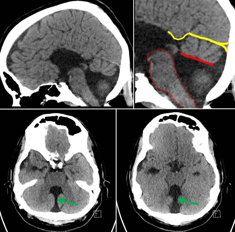 Green arrow = vermian hypoplasia. Thick red line = superior border of the fourth ventricle. Yellow line = upward sloping tentorium cerebelli. Thin red line - outline of brainstem.