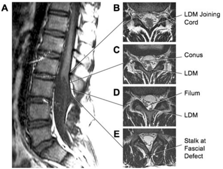 Lumbar nonsaccular (flat) LDM; a sagittal MR showing subcutaneous fibroneural stalk going through laminar defect opposite L3/4, entering dura opposite L3, and joining spinal cord at L2. b Axial image where LDM stalk joins spinal cord. Note trapezoid shape of the cord– stalk junction. c Intradural LDM stalk dorsal to the conus (low lying). d Intradural LDM stalk dorsal to thickened filum. e Extradural LDM stalk at laminar defect