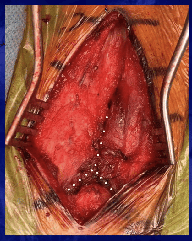 Y shaped: to allow for easier closure 