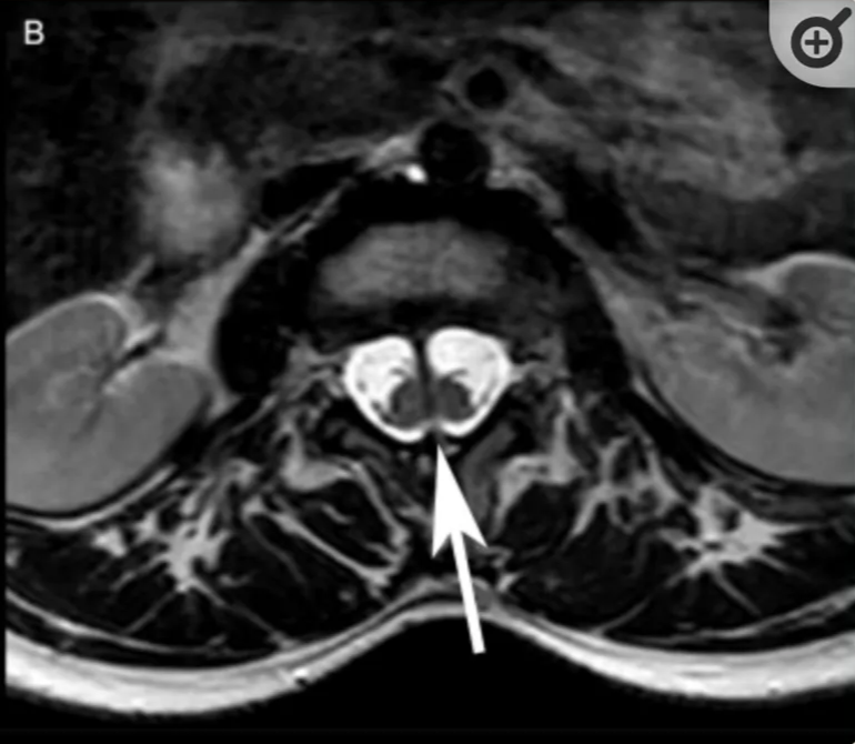 T2-weighted image, axial plane, level of L2–L3, shows two hemicords separated by the chondro-osseous ligament, each in a separate dural sac.