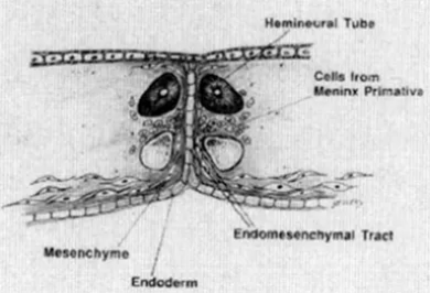 cells from meninx primativa (primitive meninges) appearing between the hemineural tube and its heminotochord.
If meninx primativa cells surround both cord it will be type 2 if it surround each cord will be type 1