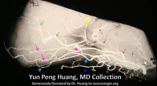 White: Inferior thalamoperforating arteries from P1
Black: PCOM
Purple: Geniculate
Red: Posterior lateral choroidal (note characteristic C-shaped curve)
Posterior pericallosal (a.k.a. splenial branch) = yellow
Calcarine = pink
Parieto-occipital = green
Posterior Inferior Temporal = light blue
Middle Inferior Temporal = dark blue
Anterior Inferior Temporal = brown