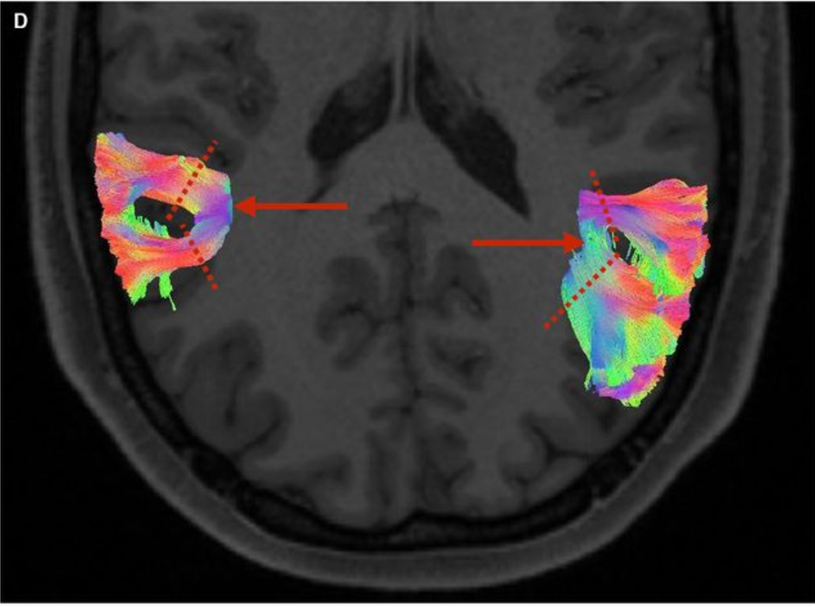 Superior axial view of posterior cerebral hemispheres, demonstrating bilateral VAFs. The red arrows indicate bifurcation of the left and right bundles, respectively. The dashed red lines represent the trajectory at which the anterior and posterior bundles were subsequently selected.