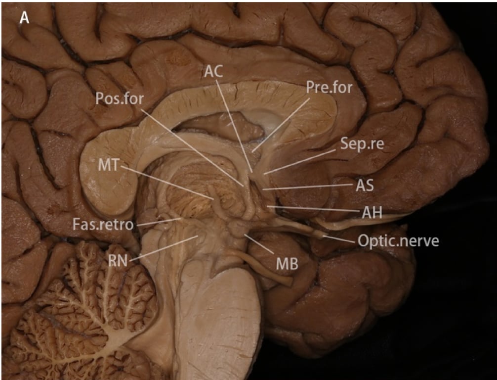 A: Part of the thalamus and septal cortex were removed to expose the precommissural and postcommissural fornix, anterior commissure, mammillothalamic tract, fasciculus retroflexus and amygdaloseptal pathway. The amygdaloseptal pathway is seen arising from the septal region (consisted of the subcallosal cortices and paraterminal gyrus) and running anterior to the body of the anterior commissure, to later turn laterally and form part of the ansa peduncularis. The amygdalohypothalamic fibers originate from the hypothalamus.