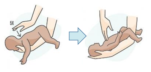 Actuación en niños < 1 año. Las compresiones son torácicas