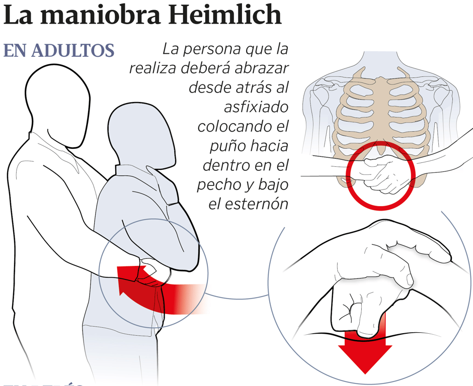 Procedimiento de realización de la maniobra de Heimlich