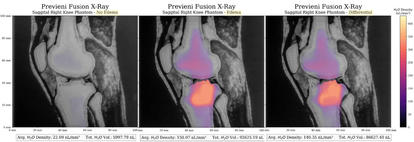 Rilemo fusion with X-Ray images - sagittal view. On the right a healthy knee without edema. In the center the same knee with presence of edema-simulating fluid. On the right, the differential between the previous pictures to highlight the monitoring capability of Rilemo’s approach.