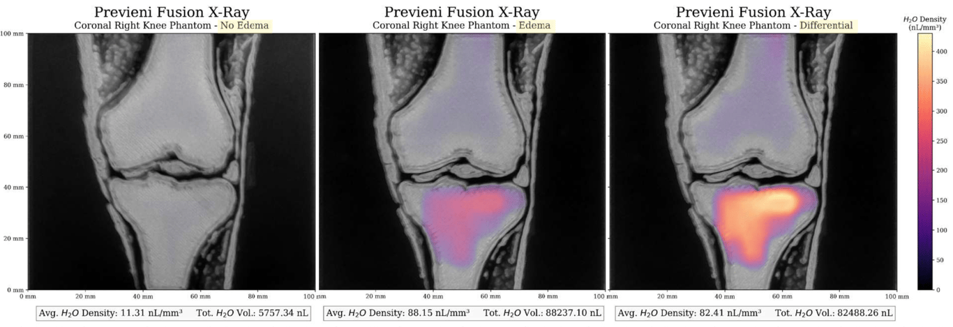 Rilemo fusion with X-Ray images - coronal view. On the right a healthy knee without edema. In the center the same knee with presence of edema-simulating fluid. On the right, the differential between the previous pictures to highlight the monitoring capability of Rilemo’s approach. 