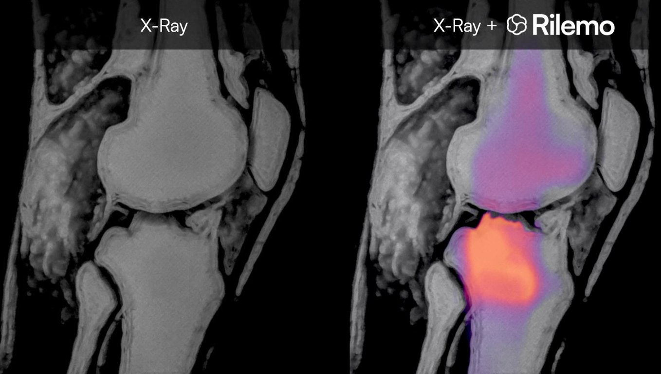 X-ray image (left) and X-ray + coloured electromagnetic imaging (right). The image shows a synthetic in-vitro phantom realised on a real human knee MRI slice filled with edema simulating fluid. The edema can’t be seen under the Xray, nor would be seen under echography (as ultrasounds don’t penetrate into bones) but it is easily seen by Rilemo in colours showing fluid concentration. Fusion with X-Ray is designed to facilitate clinical adoption and reduce training requirements. Full imaging evidence in .
