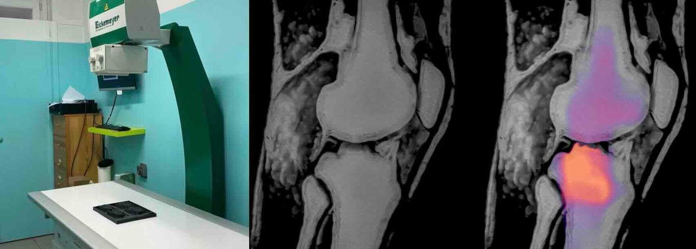 X-ray images of the synthetic sample without fluid (left) and with fluid simulating edema (right), with Rilemo’s detection overlay shown in color
