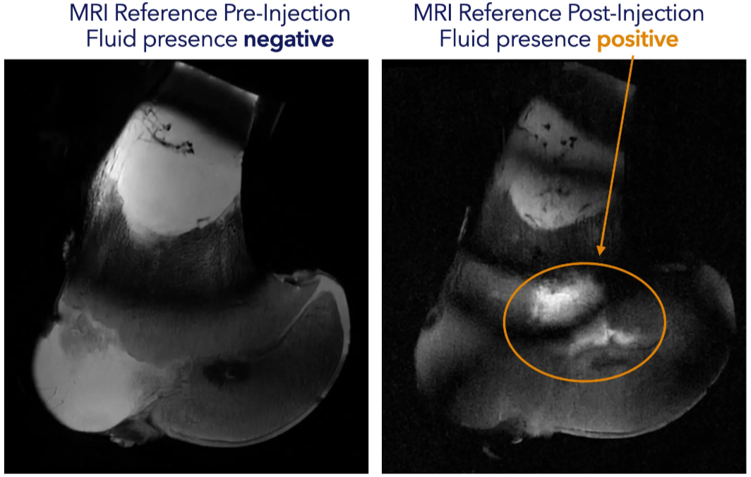 MRI ground truth image. On the left the bovine femur section in a healthy state (without white spots indicative of edema). On the right after 5mL of edema-simulating fluid were injected.