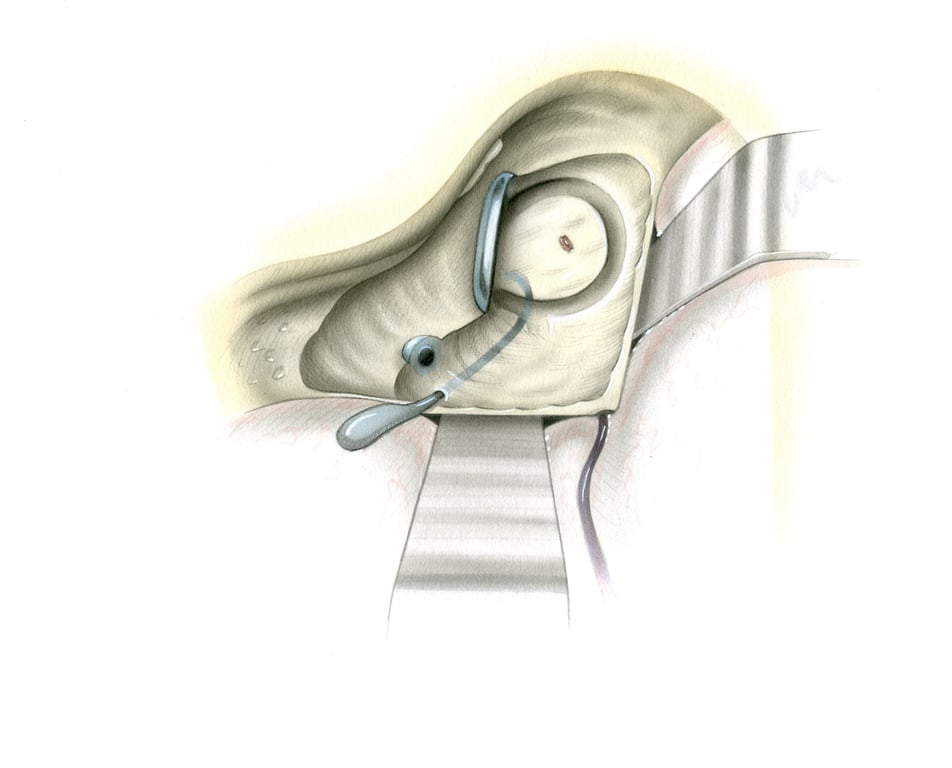 - SA, subarcuate artery - ES, endolymphatic sac - CC, common crus.