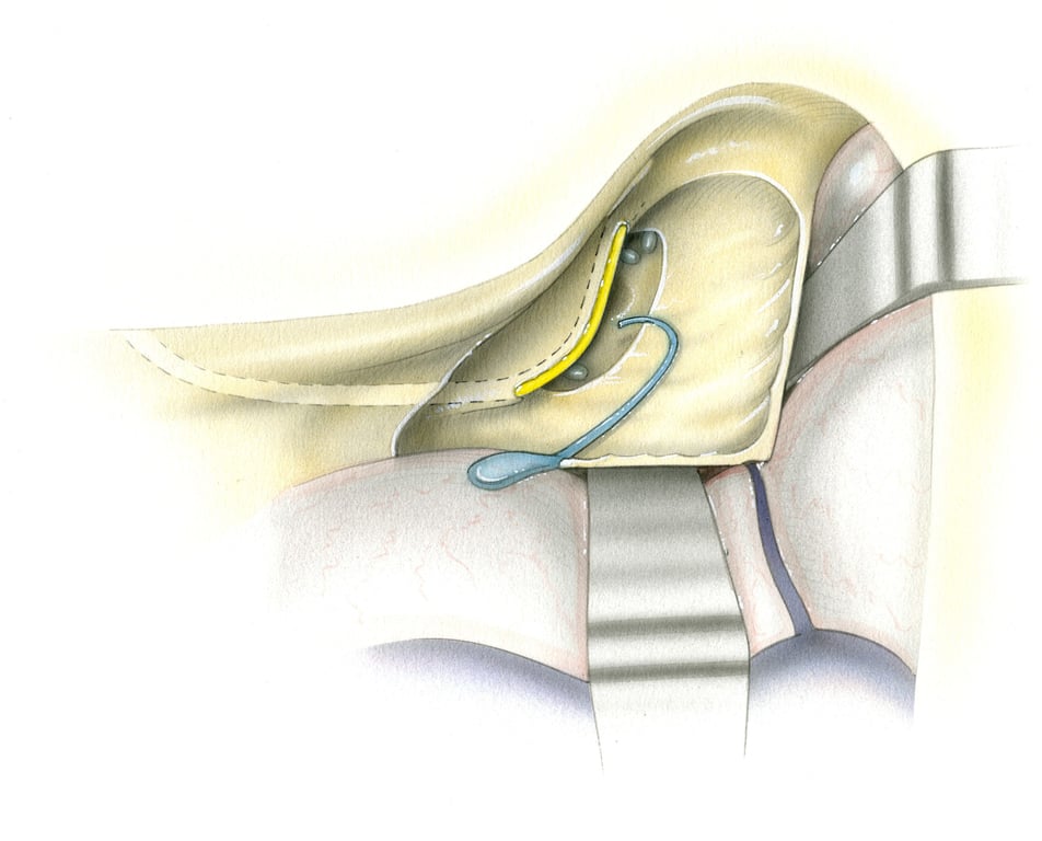 - ES, endolymphatic sac - PCA, posterior semicircular canal ampulla - FN, facial nerve - ER, eliptical recess for the utricle - LCA, lateral semicircular canal ampulla - SCA, Superior semicircular canal ampulla.