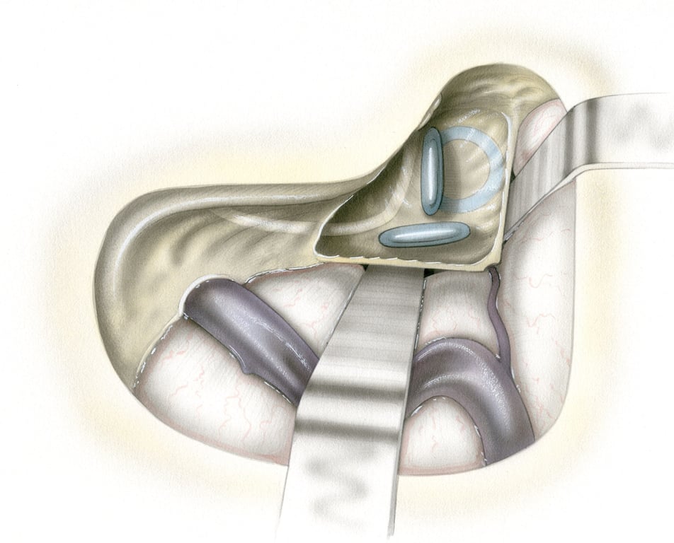 - VFN, vertical or mastoid segment of the facial nerve - 2G, second genu of the facial nerve - HFN, horizontal or tympanic segment of the facial nerve - O, ossicles in the epitympanum - SSCC, superior semicircular canal - PSCC, posterior semicircular canal - LSCC, lateral semicircular canal.