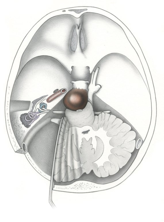 (A) Retrosigmoid approach to a pre-pontine tumor seen schematically in axial view.