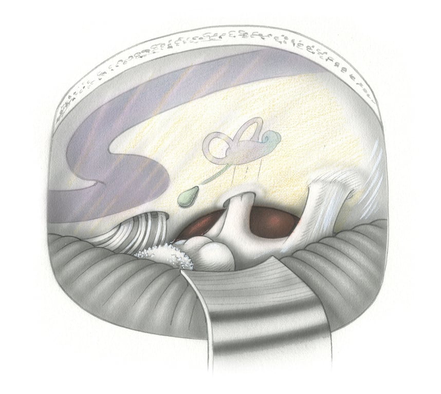 (B) Retrosigmoid approach to a pre-pontine tumor seen in surgical perspective. Exposure of the tumor is limited by interposition of the brainstem and the audiovestibular and facial nerves which bridge across the operative field. (Ch, choroid plexus-Fl, flocculus - 7, facial nerve - 8, audiovestibular nerve - 5, trigeminal nerve - JB, jugular bulb.)