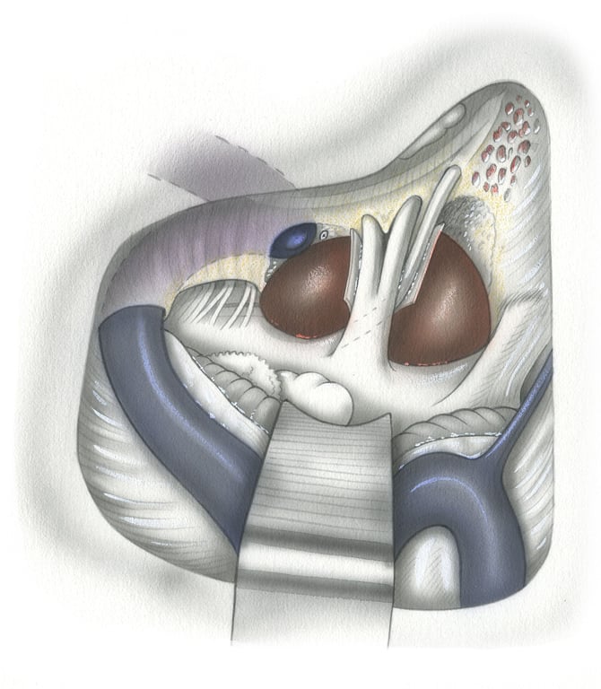 - (B) Translabyrinthine approach to a pre-pontine tumor seen in surgical perspective. Ventral exposure superior to the retrosigmoid approach, but is still limited by the lateral aspect of pons and the VII-VIII complex. (5, trigeminal nerve - 7, facial nerve - 8, audiovestibular nerve.)