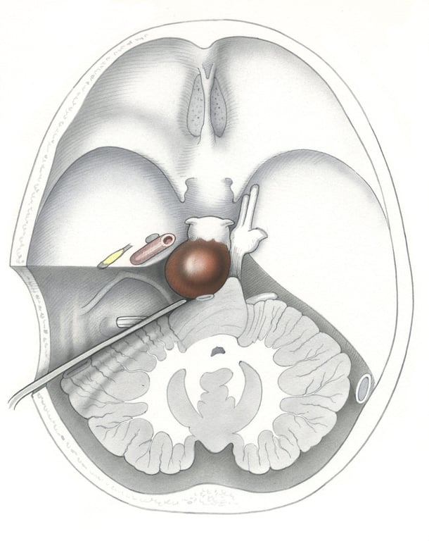 (A) Transcochlear approach approach to a prepontine tumor seen schematically in axial view. (ET, eustachian tube CA, carotid artery.)