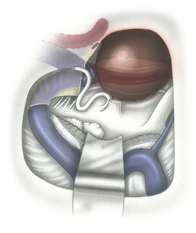 - (B) Transcochlear approach to a prepontine tumor seen in surgical perspective. By re-routing the facial nerve and exenterating the entire otic capsule, petrous apex, and lateral aspect of the clivus an unobstructed view is obtained of the ventral aspect of the pons. (TS, transverse sinus - SS, sigmoid sinus - JV, jugular vein - SPS, superior petrosal sinus - Ch, choroid - Fl, flocculus - ET, eustachian tube - Cb, cerebellum - 5, trigeminal nerve - 6, abducens nerves - 7, posteriorly rerouted facial nerve - 8, transected audiovestibular nerve.)