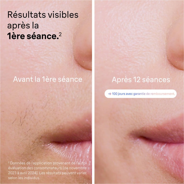 Epilateur a lumiere pulsée - BRAUN - IPL PL7253 - 240 V - 400 000 Flashs - Or rose / Blanc - Neuf