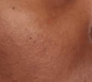 CELORABY - POTENSION™ PENTASHOT: 3rd-Gen Pore Care Device