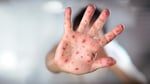 Image for Unvaccinated adult tests positive for measles in Wayne County, heath department says