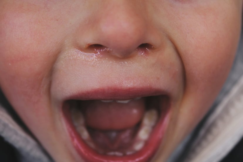 A screaming child showing their teeth