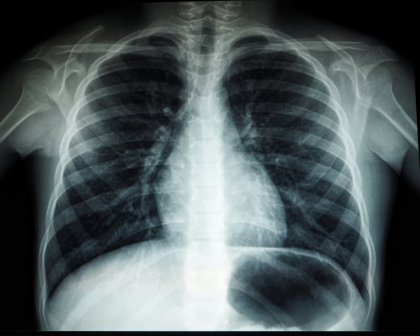 An X-ray of a rib cage and chest