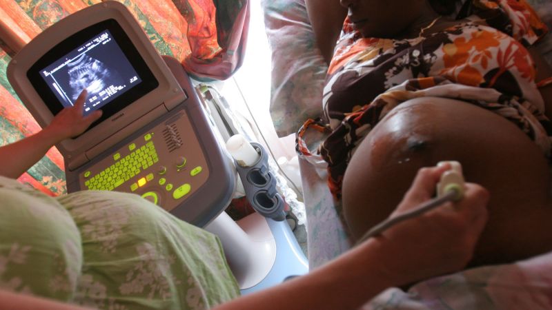 CNN image for The Trump admin said it would prioritize ending mother-to-child HIV transmission. Health workers say it cut services - CNN