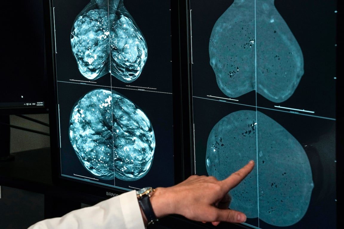 The Washington Post image for Cancer cases worldwide are expected to soar in the coming decades, a report finds. Here’s why. - The Washington Post