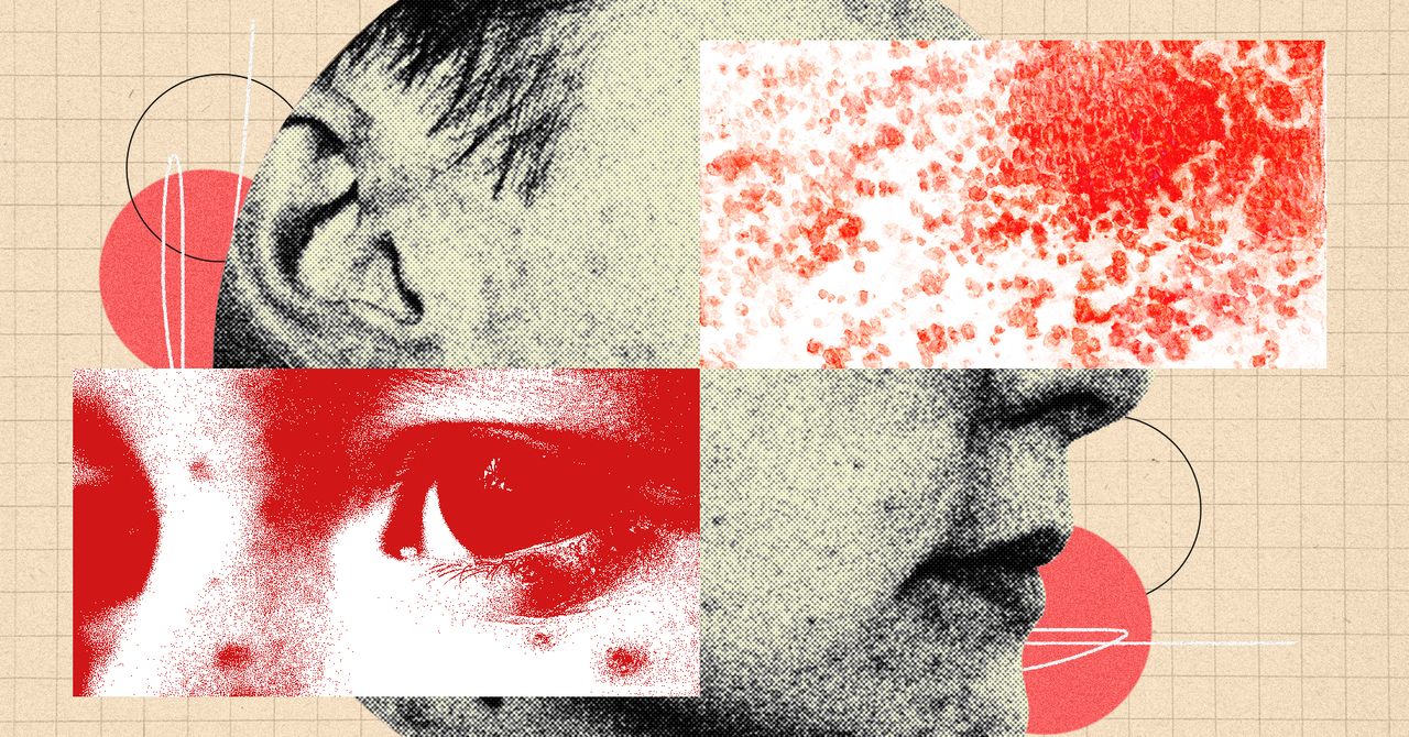 Wired image for You Need to Be More Freaked Out by Shingles - WIRED