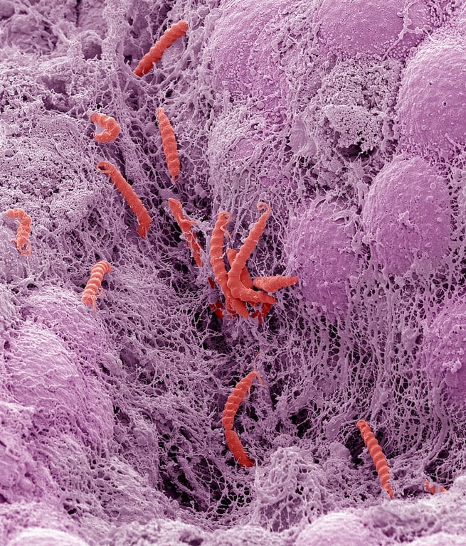 The Washington Post image for These common infections can cause cancer. Here’s what can lower your risk. - The Washington Post
