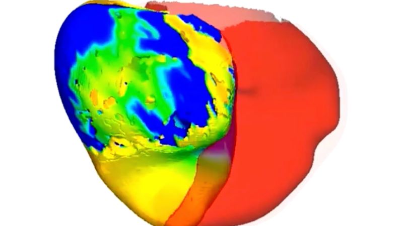 CNN image for To fix a patient’s irregular heartbeat, doctors first tested its digital ‘twin’ - cnn.com