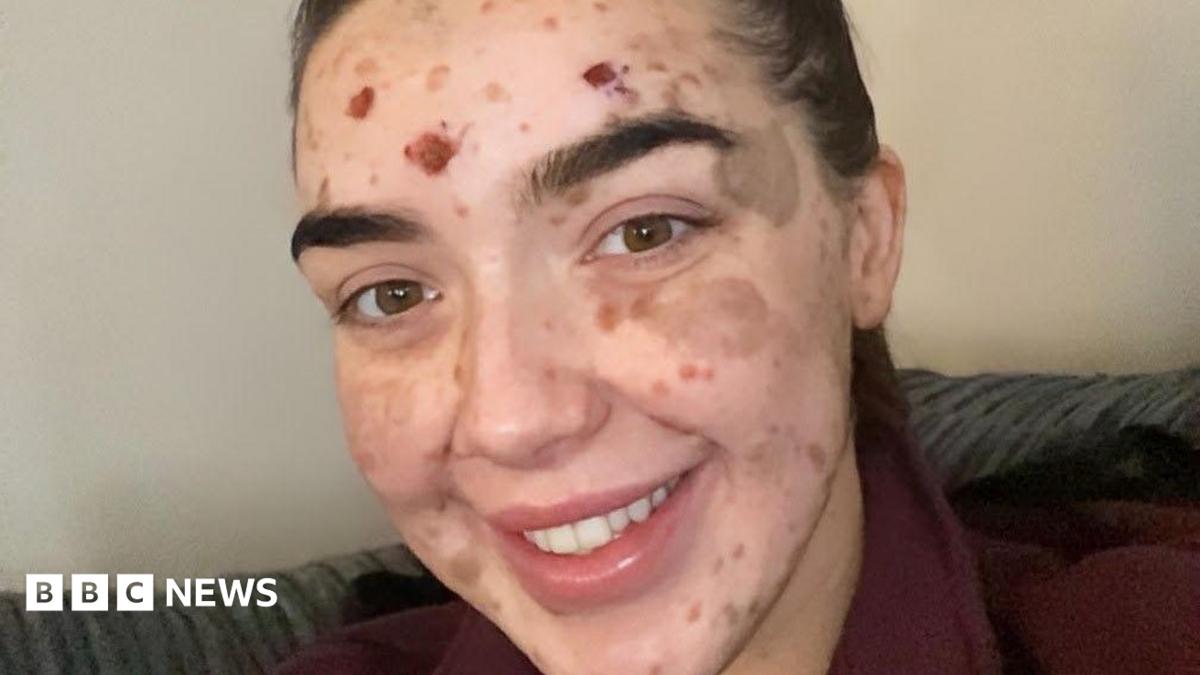 BBC News image for CMN: 'I am slowing learning to embrace my rare skin condition'