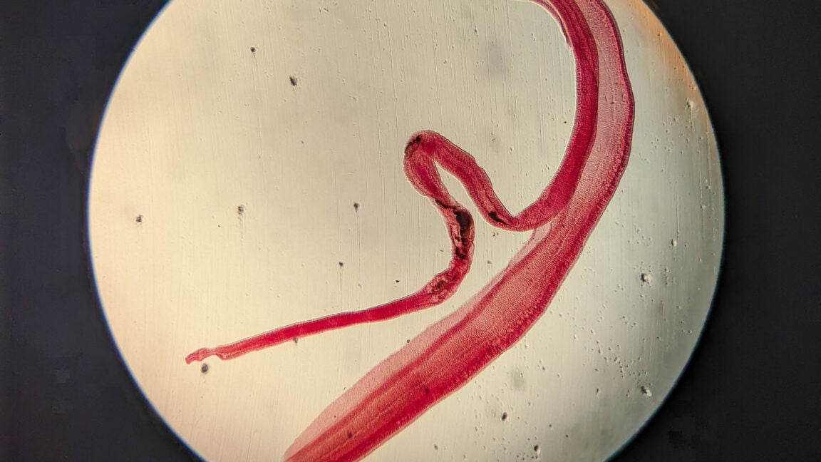 Ars Technica image for Woman’s brain worm infection confirmed after eggs grow tails in lab test - Ars Technica
