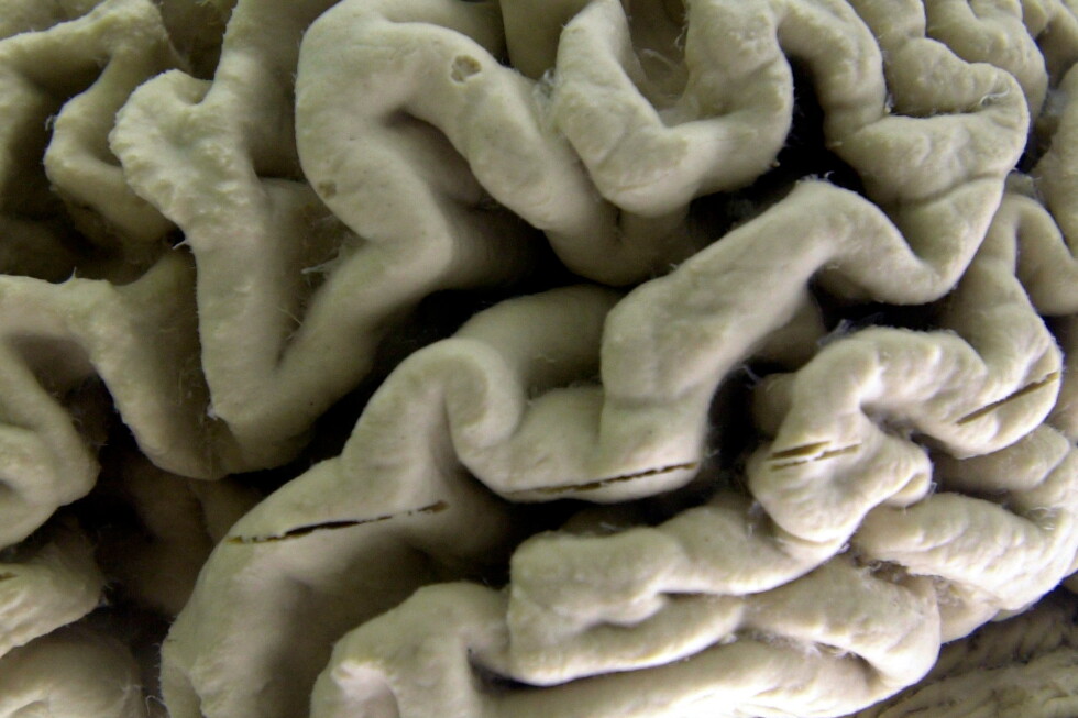Associated Press image for Study shows a blood test can help identify healthy people at high risk for Alzheimer's disease - AP News