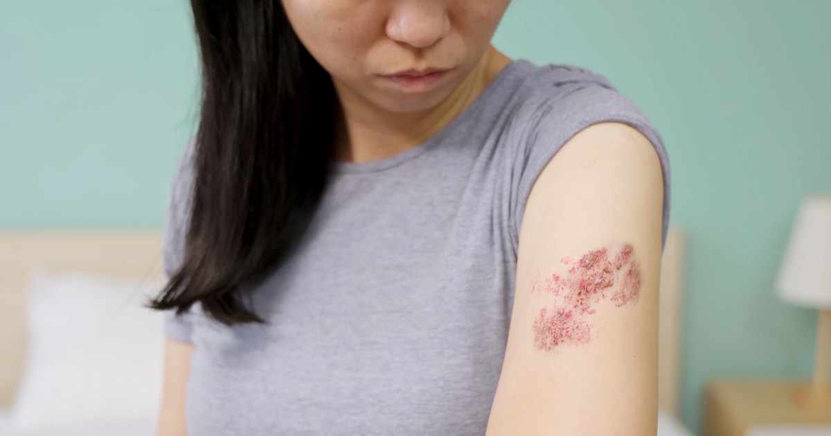 NBC News image for Shingles cases dropping among people who got chickenpox vaccine, data shows - NBC News
