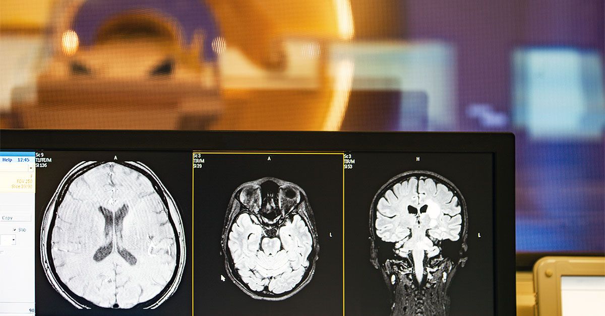 Medical News Today image for Brain aging: Gut microbiome may drive memory loss via vagus nerve - Medical News Today