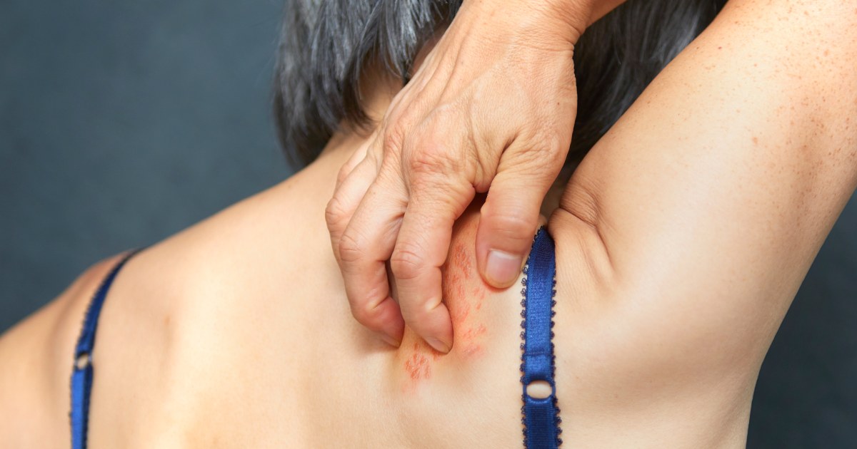NBC News image for Shingles vaccine may also offer protection against dementia, studies increasingly show - NBC News