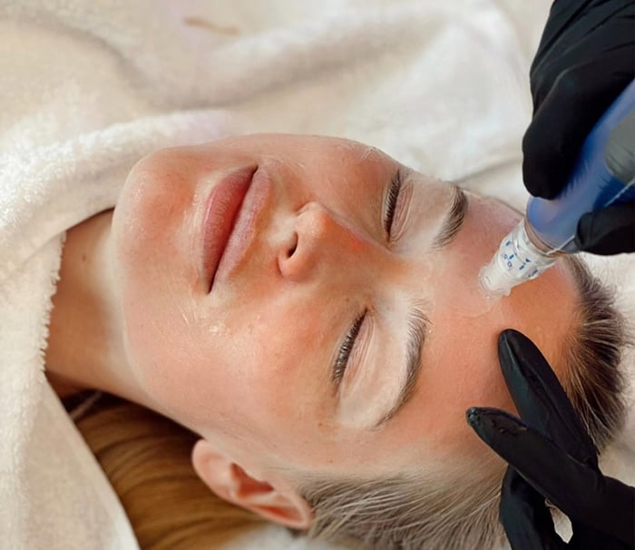 Microneedling-Behandlung mit präziser Handführung