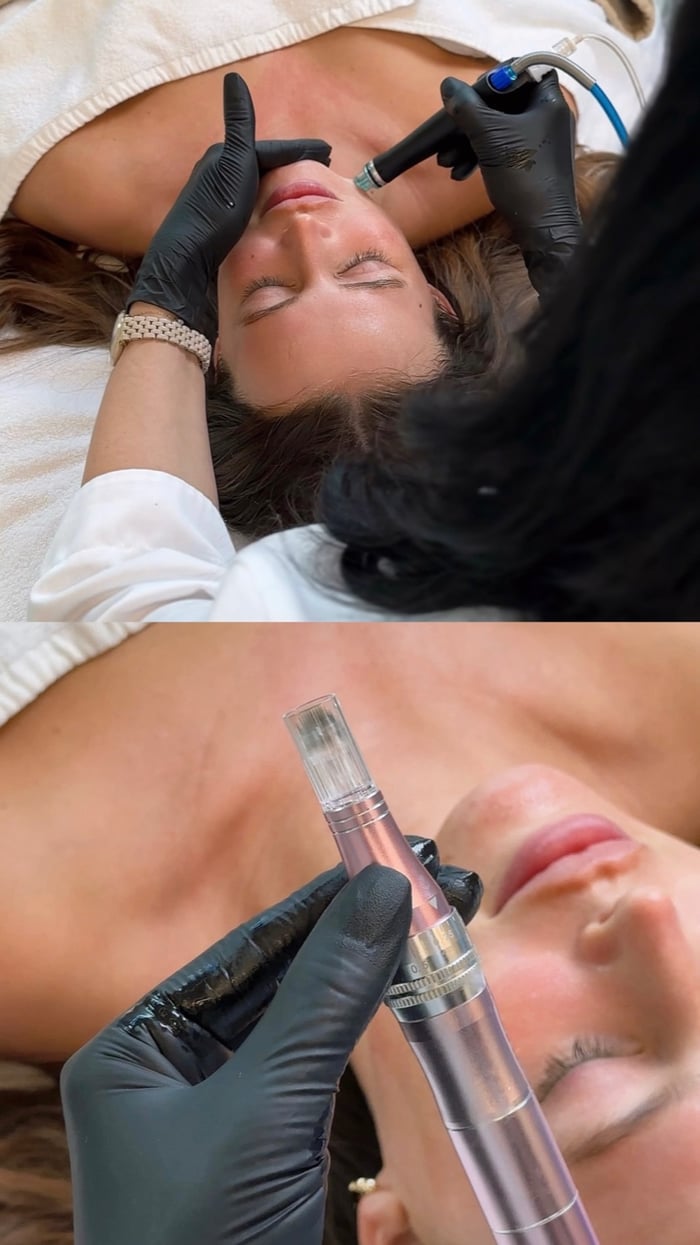 Hydro-Gesichtsbehandlung und anschließendes SkinPen Microneedling