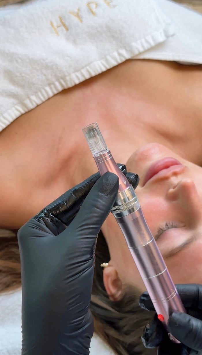 SkinPen Microneedling-Behandlung im HYPE Studio