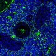 Estudio revela que las células cancerosas compiten a favor y en contra del desarrollo del tumor