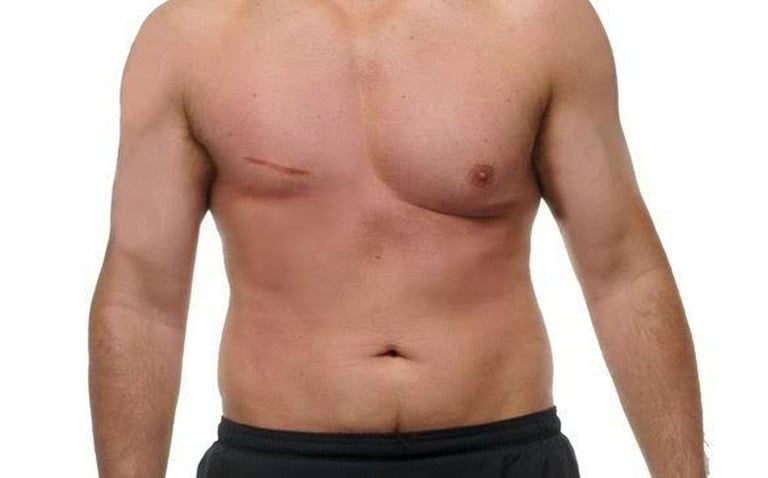 Cáncer de mama en hombres: por qué pocos saben que existe y cómo prevenirlo